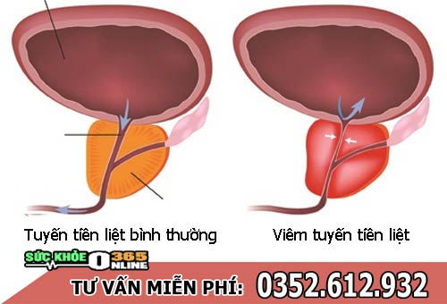 Cách chữa viêm tuyến tiền liệt
