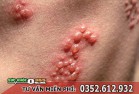 Mụn rộp sinh dục (Herpes): Triệu chứng, hình ảnh & cách chữa