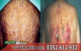 Bệnh giang mai có chữa khỏi được không?