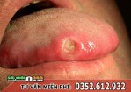 Bệnh giang mai ở miệng, lưỡi: Triệu chứng và cách điều trị