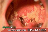 Bệnh lậu ở miệng, họng: Triệu chứng, hình ảnh, cách chữa