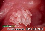 Bệnh sùi mào gà có chữa khỏi dứt điểm được không?