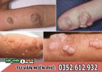 Bệnh sùi mào gà có gây ngứa không?