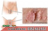 Bệnh sùi mào gà có nguy hiểm không? Tác hại như thế nào?