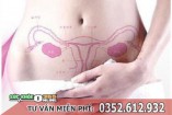 7 Cách chữa viêm cổ tử cung tại nhà hiệu quả dứt điểm