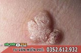 Bệnh mụn cóc sinh dục có phải sùi mào gà không?