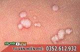 Mụn cóc sinh dục ở nam, nữ là gì, có nguy hiểm không?