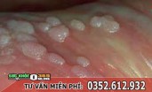 Nổi mụn trắng ở bao quy đầu và ngứa là bệnh gì? Cách chữa trị