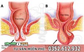 Sa búi trĩ là gì, có nguy hiểm không? Cách chữa sa búi trĩ