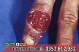 Săng giang mai là gì? Có đau, ngứa không? Mọc ở đâu?