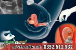 Vô sinh có thụ tinh nhân tạo được không?