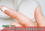 Vùng kín bị ngứa và có dịch trắng như bã đậu vón cục mùi hôi