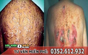 Bệnh giang mai có chữa khỏi được không?