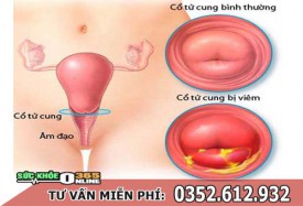 Bệnh viêm cổ tử cung: Nguyên nhân, triệu chứng, hình ảnh và điều trị
