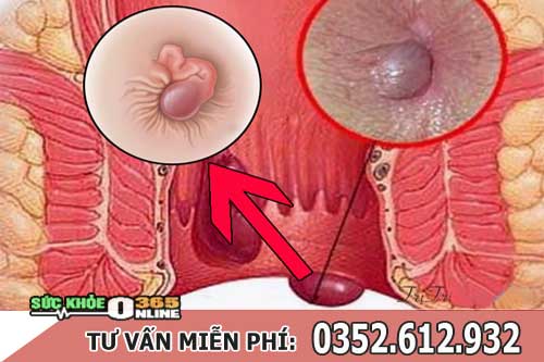 15+ Cách Làm Co Búi Trĩ Ngoại Có Thể Áp Dụng Tại Nhà