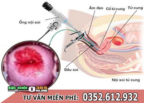 Đốt viêm lộ tuyến cổ tử cung có đau không, nên đốt không?